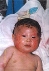 アトピー性皮膚炎　赤ちゃん