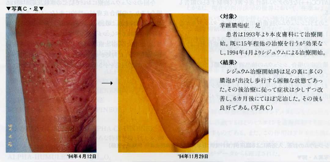 シジュウムのお茶、入浴剤による臨床例　３、＜対象＞掌蹠膿疱症　足　患者は、1993年より本皮膚科にて治療開始。既に15年程他の治療を行うが効果なし。1994年よりシジュウムによる治療開始。　＜結果＞　シジュウム治療開始時は、足の裏に多くの膿泡が出没し歩行すら困難な状態であった。その後治療に従って症状は少しずつ改善し、６カ月後にほぼ完治した。その後も良好である。（写真Ｃ）