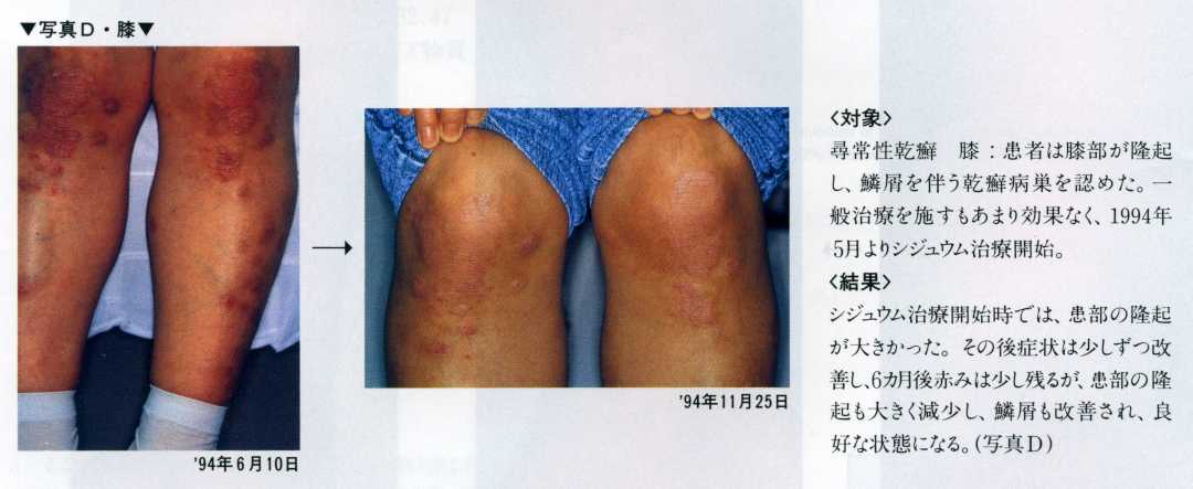 シジュウムのお茶、入浴剤による臨床例　４、＜対象＞尋常性乾癬　膝：患者は脚部が隆起し、麟屑を伴なう乾癬病巣を認めた。一般治療を処すも効果なく、1994年５年よりシジュウム治療を開始。　＜結果＞　シジュウム治療を開始時では、患部の隆起が大きかった。その後の症状は少しずつ改善し、６カ月後赤みは少し残るが、患部の隆起も大きく減少し、麟屑も改善され、良好な状態となる。（写真Ｄ）　