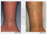 尋常性乾癬　脚部　臨床試験　
